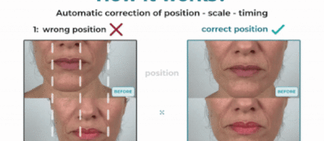 Your facial Before-and-Afters now perfectly standardized