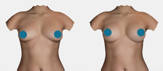 10 reasons why Crisalix is the #1 online 3D simulator for Plastic surgery
