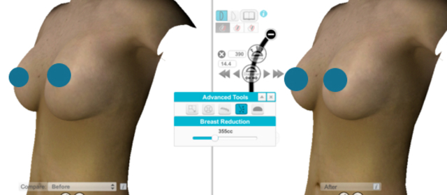 Nouvelles fonctionnalités: réduction du volume, changement d'implant et cas asymétriques