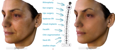 Nouveau simulateur 3D du visage: simulez dorénavent toute opération du visage en un seul click