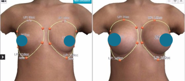 Escanea ilimitados post-op 3D para el análisis de resultados